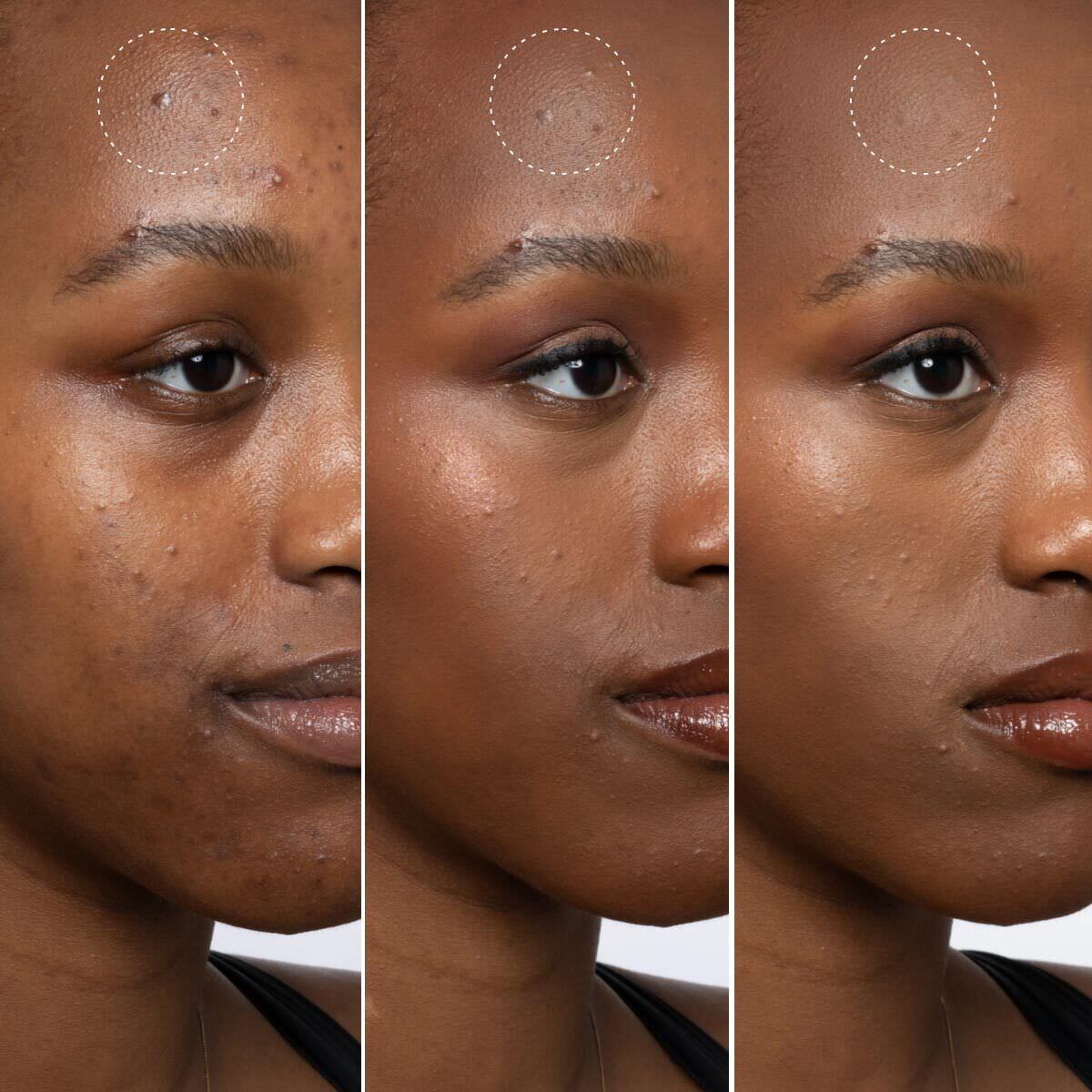 BLEMISH DEFEAT'R BHA SPOT TARGETING GEL (GEL FACIAL CON ÁCIDO SALICÍLICO)